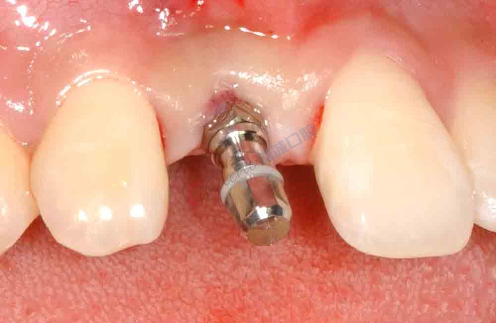 微创种植牙手术,创伤最小