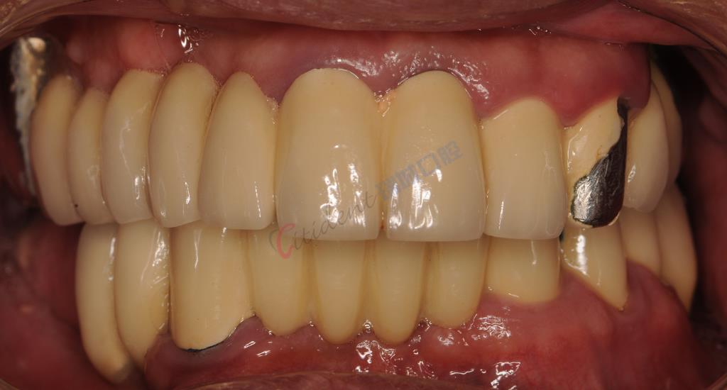 治疗前,口内烤瓷固定桥修复,部分牙冠边缘不弥合,牙龈炎症明显